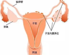 痛经是因为什么原因引起的