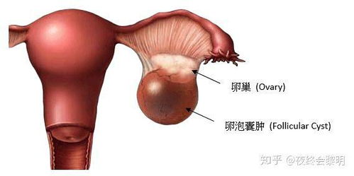 卵巢方面有哪些严重的疾病