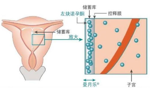 曼月乐环和其他环的区别