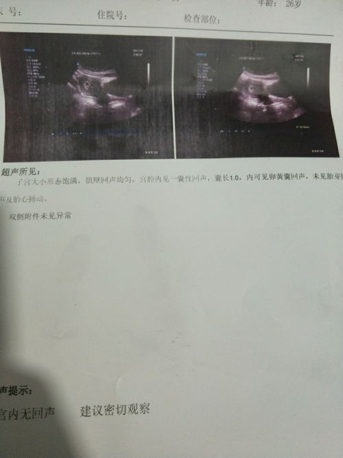 怀孕10周的孕囊正常应该是多大