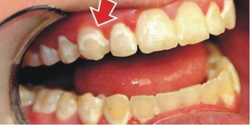 粘上的假牙和牙龈有缝隙会影响假牙的寿命吗