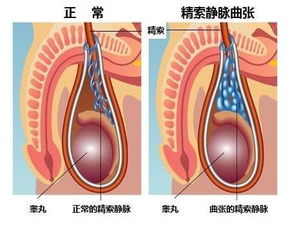 青少年会有精索静脉曲张吗?