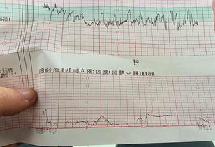 胎心监护结果怎么看