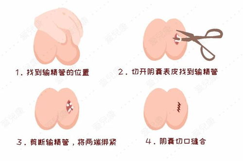 做了结扎手术还需要避孕吗