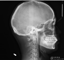 36周股骨小于4周正常吗