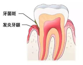 脐动脉未见反向血流信号