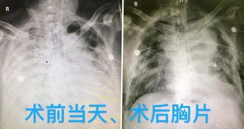 移植冻胚前打生长激素