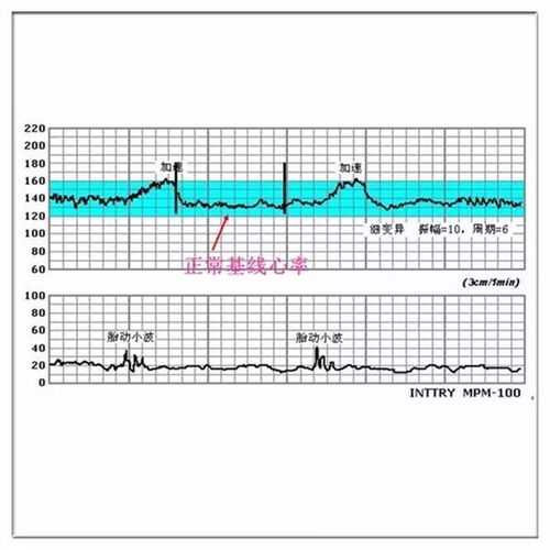 胎心监护图怎么看结果图