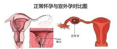 宫外孕手术痛吗