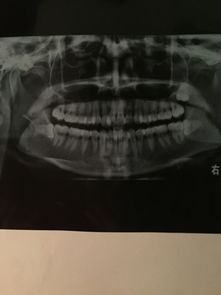 拔上颌智齿要拍片吗图片