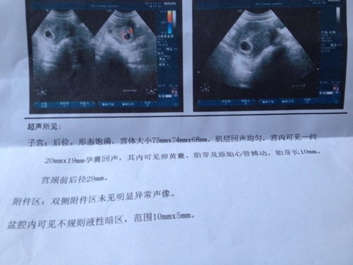 46天还没有胎芽正常吗，孕囊周围有少量积液就是先兆流产吗？