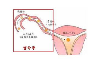 怀孕了如何判断是不是宫外孕