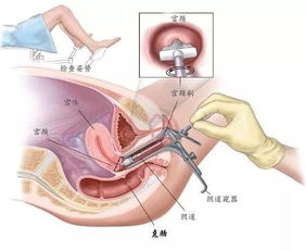 检查子宫有异常细胞是什么意思