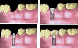 种植牙的一般过程是怎样的啊？