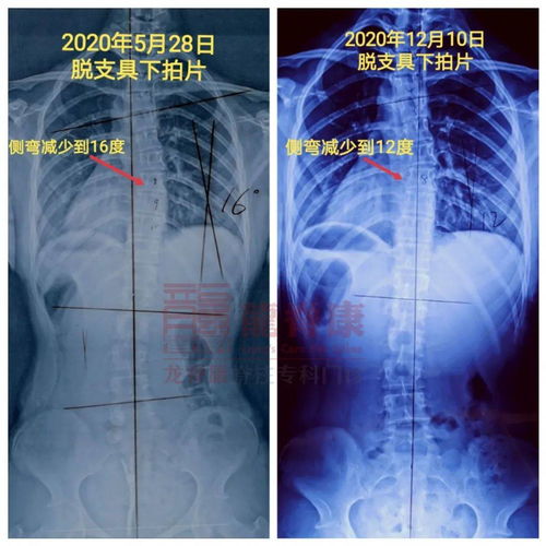 孩子十三岁骨龄还是十岁咋办