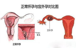 宫外孕由哪些原因所引起的