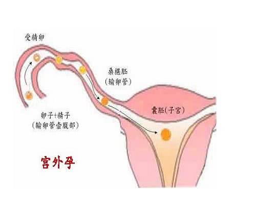 宫外孕由哪些原因所引起的