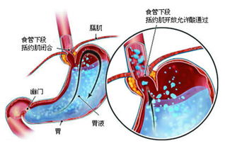 胆结石能吃肯德基吗