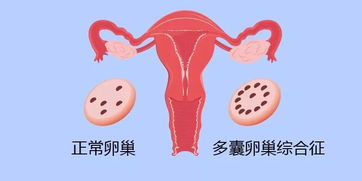 多囊卵巢综合征严重可以怀孕吗