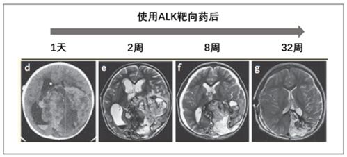 三岁小孩得了尖锐湿疣怎么办