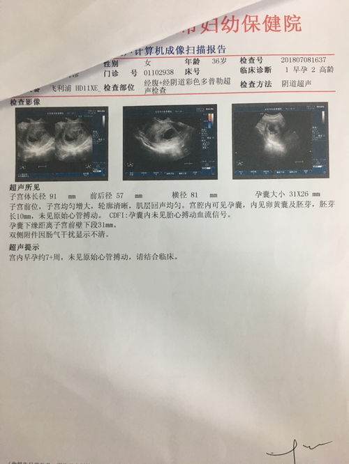 有胎芽但无胎心