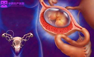宫外孕是怎样引起的宫外孕