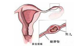 宫外孕是怎样引起的宫外孕
