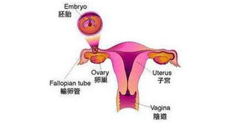 宫外孕是怎样引起的宫外孕