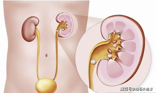 孕妇肾结石疼痛怎么办吃什么