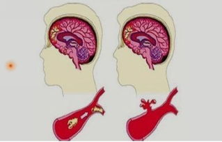 如何预防脑卒中发生