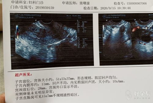 盆腔积液13毫米，能正常排卵吗？