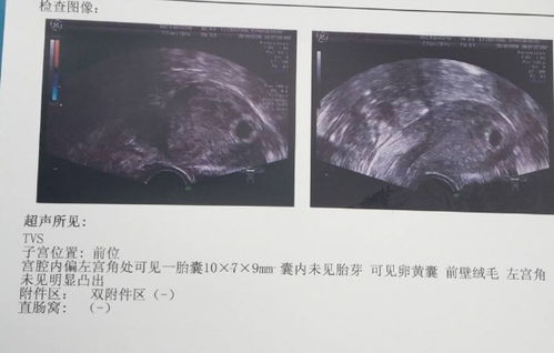 怀孕50天左右，彩超显示孕囊2.6*1.7，似探及胚芽原始心管搏动正常吗