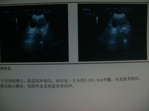 怀孕50天左右，彩超显示孕囊2.6*1.7，似探及胚芽原始心管搏动正常吗