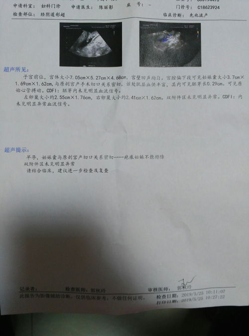 阴超查不出来孕囊怎么回事