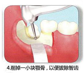 怀孕期间可以拔牙吗?已经松了