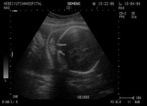 胎儿脊柱裂超声表现报告单