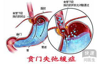 卵巢癌导致的便秘是什么情况