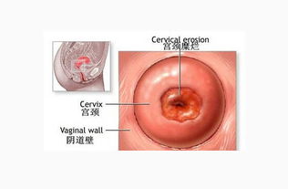 宫颈糜烂不能同房嘛