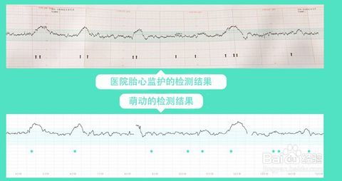 帮我看看胎儿是否宫内缺氧