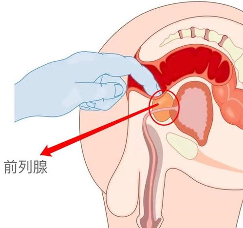 前列腺穿刺手术后需要注意的事项