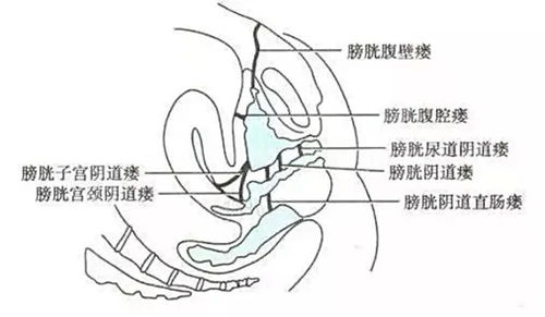 盆腔结核怎么确诊好了