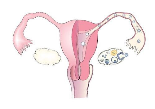 多囊卵巢容易怀双胞胎吗