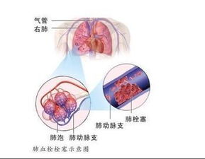 妊娠相关静脉血栓栓塞的治疗原则