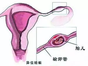 输卵管粘连但想怀孕怎么办