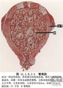 怀孕葡萄胎危险吗