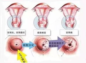 宫颈tct检查轻度炎症需要治疗吗