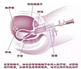 做宫腔镜手术后多久可以知道是否恢复呀