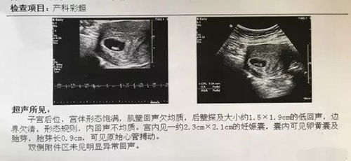 我怀孕29周检查出胎儿双肾盂分离左0.9CM，右0.7CM