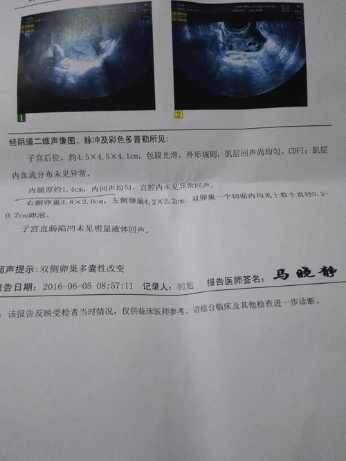 促卵泡生成素高会影响月经吗