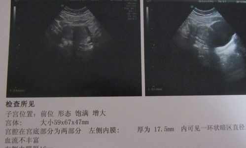 孕妇白蛋白低的原因及危害